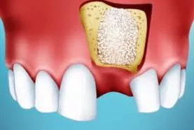 Bone Grafting